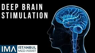 Deep Brain Stimulation (DBS) - Istanbul Medical Assistance