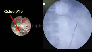 Scope Damage while removing the Guide Wire