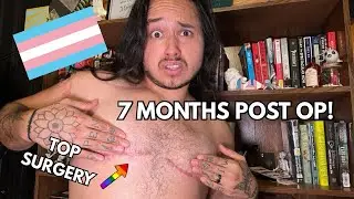 7 MONTHS POST OP! (FTM TOP SURGERY)