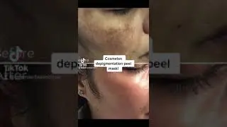 #cosmelan Depigmenration Peel #shorts #pigmentation #pigmentationsolution