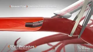 Vascular Institute of the Rockies is Pleased to Offer TCAR