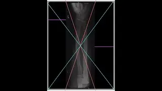 PACEMAN explaination for AP forearm (radius ulna) projection