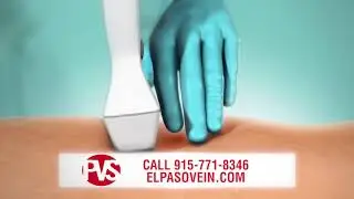 New, Innovative Vein Treatment VenaSeal - at Physician's Vascular Services - El Paso TX