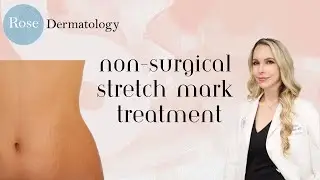 Stretch Marks- what can you do about them?