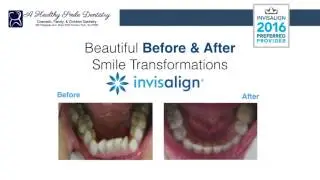 A Healthy Smile Dentistry: Invisalign before and afters