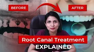 Root Canal Treatment: Say Goodbye to Tooth Pain with Expert Insights!