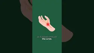 What Is Carpal Tunnel Syndrome? Signs, Causes, and When to Get Help