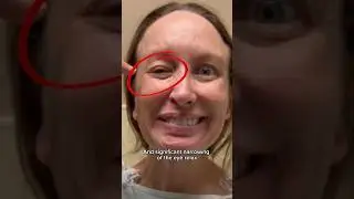 Facial reanimation surgery pre-op #facialparalysis #plasticsurgery #drazizzadeh
