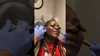 Facial Balancing w/ Cheek Filler🪄