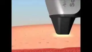 NUTRA SYSTEM - BUZ LAZER EPİLASYON ORTALAMA KA&Ccedil; SEANS S&Uuml;RER?