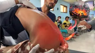3rd Grade AVN - No Surgery ❌ अग्निकर्म और आयुर्वेद ईलाज से डॉ. अमित प्रसाद सर और टीम करेंगे ठीक ✅ 