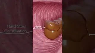 How Constipation Blocks Your Colon | 3D Digestive System Animation