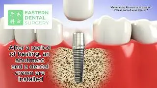 Dental Implants to replace missing teeth