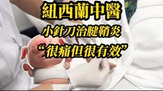 腱鞘炎做小針刀效果是非常明顯呀Acupotomy looks like much better for Tenosynovitis than traditional acupuncture~