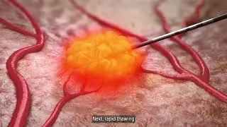 Криоабляция: как это работает