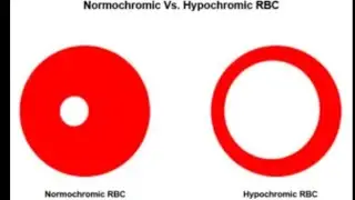 Hypochromia (an abnormal red blood cell) | anaemic condition