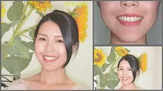 Open Bite Correction - 2020 AAO Winter Chris Chang - 1｜【Chris Chang Ortho】CC541