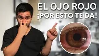 ALERTA! Por Esta Peligrosa Razón Tendrás Ojo Rojo (Y COMO EVITARLO)