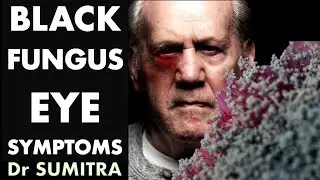 Black Fungal infection - EYE symptoms of Mucormycosis | Dr Sumitra