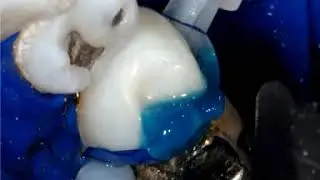 Bioclear Veneers - Replacing Old Almalgam