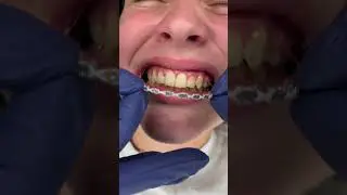 Braces Off !