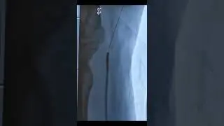 BAT Technique  #BAT #RadialFirst