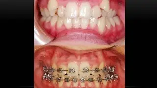High Canine Teeth! Orthodontist