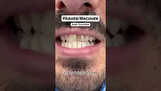Toter ☠️ Zahn ➡️ Neues L&auml;cheln ohne Schleifen #flowableinjectiontechnique #veneers #zahnarzt