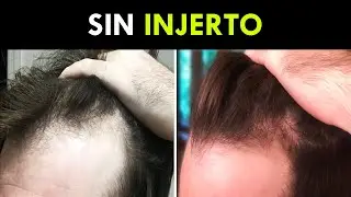 Su Pelo Vuelve De La Tumba En 4 Meses