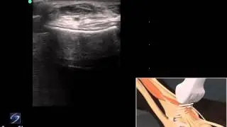 Démo 3D : échographie du tendon extenseur de la cheville - Échographe SonoSite