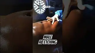 Transforming the Male Form: Before & After Ab Etching with Dr. Luster! 💪✨