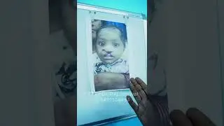 Cleft lip and palate Treatment  || Dr. Raj Jaiswal || Treatment  #shortvideo