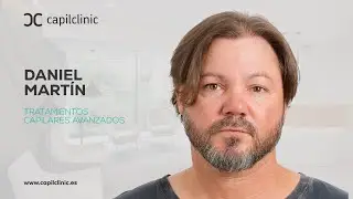 😲 Volver a tener pelo sí es posible | El cambio de Daniel a los 46 #injertocapilar