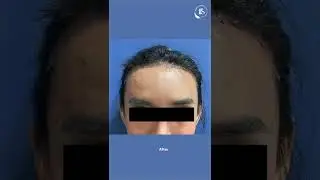Hairline Advancement for receding Hairline | #ffssurgery #facialfeminization #shorts #youtubeshorts