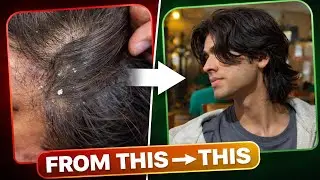 I Removed My Dandruff & Fixed My Hair in 7 Days