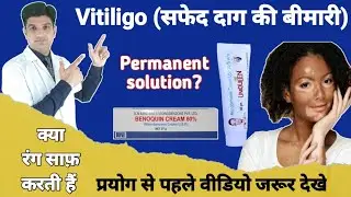 Vitiligo Parmanent treatment | Monobenzone cream for skin lightening