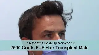 Male with Norwood 5 - FUE Post-Op 14months