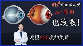 近視600度＝失明預備軍？黃斑部病變機率飆41倍！醫師警告：雷射手術也救不了你