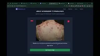 AI Skin Cancer Detection System | Deep Learning Project | Python