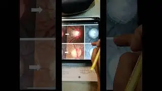 Myopia । Quick Optha 