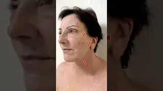 Full Facelift in istanbul | Turkey Plastic Surgery Clinic 🇹🇷