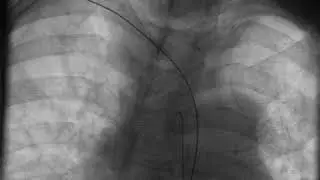 Transradial Access - Video 5.11
