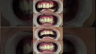 restoring missing teeth.
