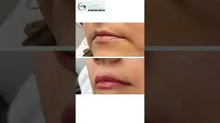 ✨ **Full Syringe vs. Half Syringe of Filler &ndash; Which One is for You?** ✨