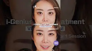 [FREE TRIAL] The 🔥ULTIMATE EYE BAG TREATMENT🔥 | i-Genius Eye Treatment with New Beauty SG