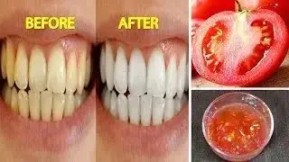 The Ultimate Teeth Whitening Method: Tomato And Lemon Hack!
