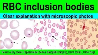 Thin film comment part 3: Red blood Cell Inclusion Bodies made easy | Hematology