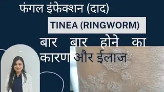 Fungal infections (Tinea/ ringworm). Cause, treatment. #tinea #fungalinfections #ringwormtreatment 