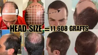 Dr. Pittella Head Size Changes The Number of Grafts- Here's Why