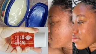 REMOVE DARK KNUCKLE DARK SPOTS AND PIMPLES IN 3 DAYS SKIN BALANCE - Skin Care